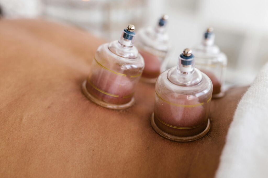 Detailed image of cupping therapy on a person's back, showcasing alternative medicine practice.